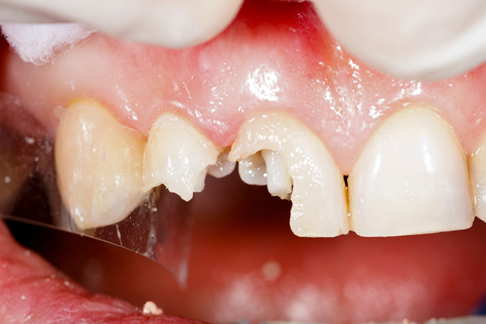 tooth-restoration